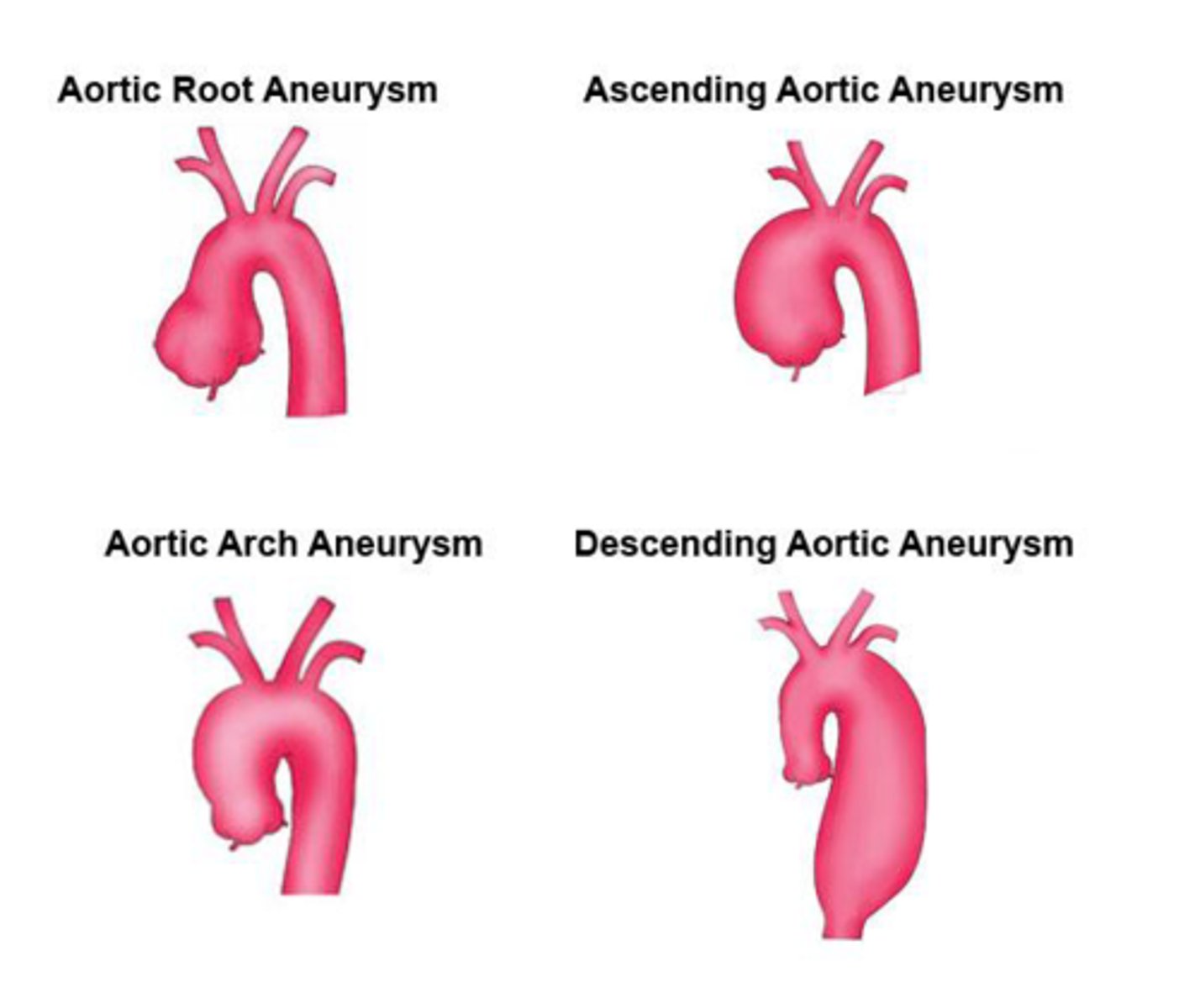 <p>- S/S: angina, TIAs, SOB, dysphagia</p><p>- If pressing on the superior vena cava, decreased venous return, JVD, edema of face &amp; arms</p>