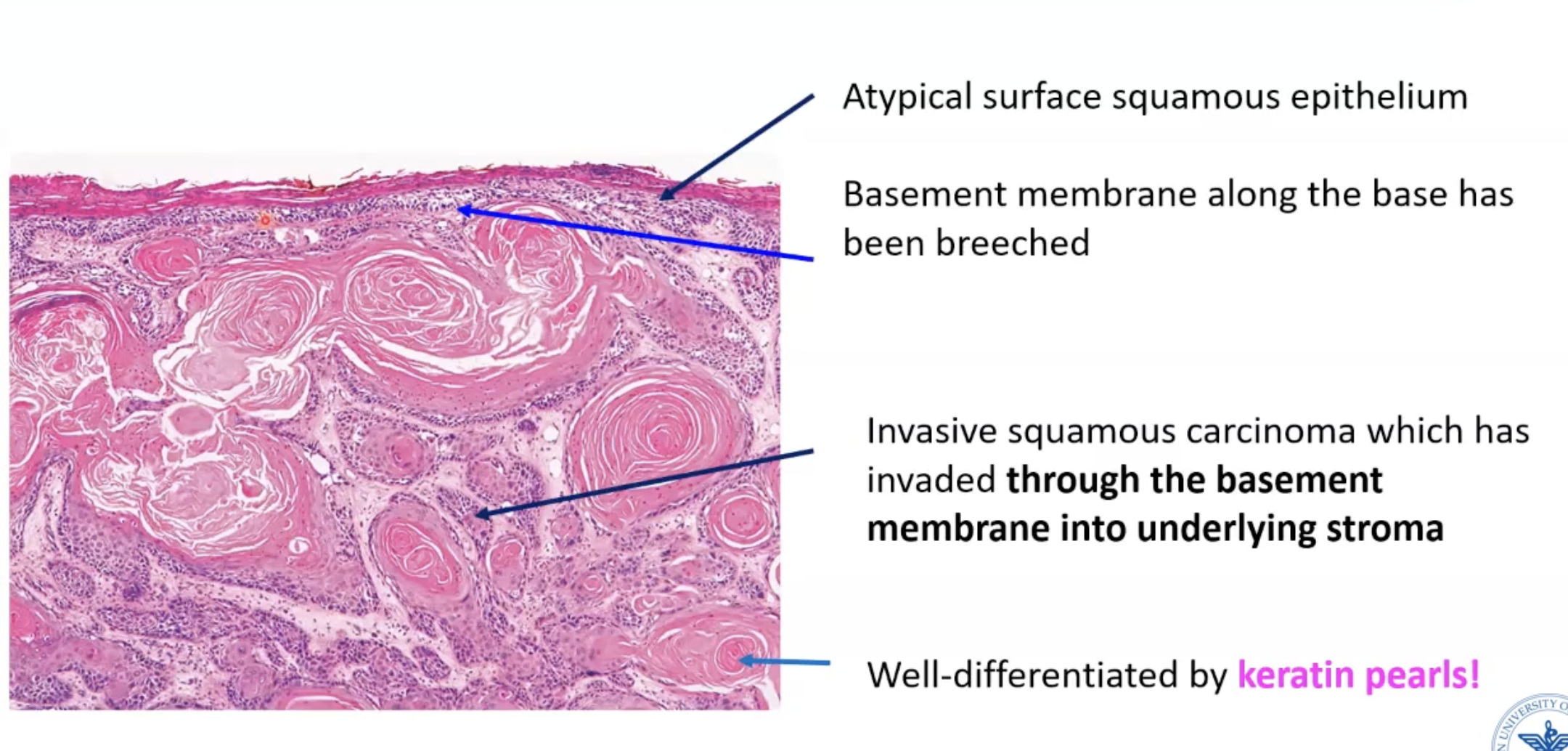 <p>KERATIN PEARLS!</p><p>Keratin is really bright pink</p><p>“Round nests” usually indicates invasive&nbsp;</p>