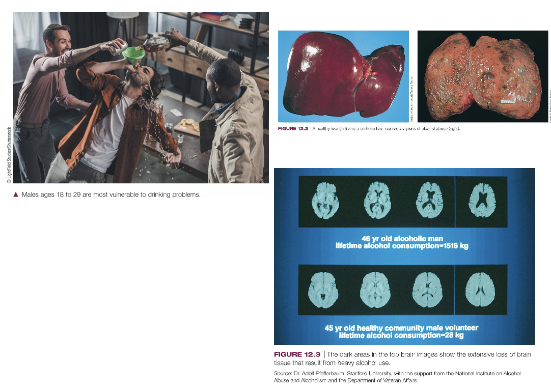 <ul><li><p><span style="background-color: transparent;"><span>Consequences of long-term excessive drinking include liver disease, pancreatitis, cardiovascular disorders &amp; brain damage</span></span></p></li></ul><p></p><ul><li><p><span style="background-color: transparent;"><span>The dark areas in the top brain images show the extensive loss of brain tissue that result from heavy alcohol use.</span></span></p><ul><li><p><span style="background-color: transparent;"><span>Ventricles enlarged</span></span></p></li></ul></li></ul><p></p><ul><li><p><span style="background-color: transparent;"><span>Healthy liver (left) and a cirrhotic liver scarred by years of alcohol misuse (right)</span></span></p></li></ul><p></p>