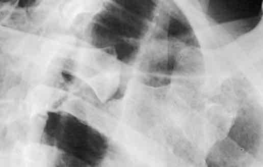 <p>What is this x-ray demonstrating?</p>
