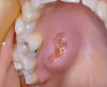 <p>In what age group might you see pleomorphic adenoma?</p>