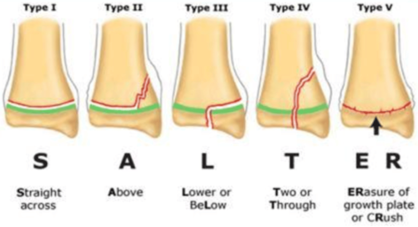 <p>S: straight through (type I)</p><p>A: above (type II)</p><p>L: lower (type III)</p><p>T: through or transverse or together (type IV)</p><p>R: ERasure of growth plate (type V)</p>