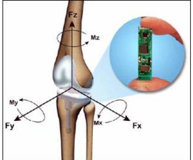 <p>implanted in knee joint and provide ongoing information on forces and torques in joint</p>