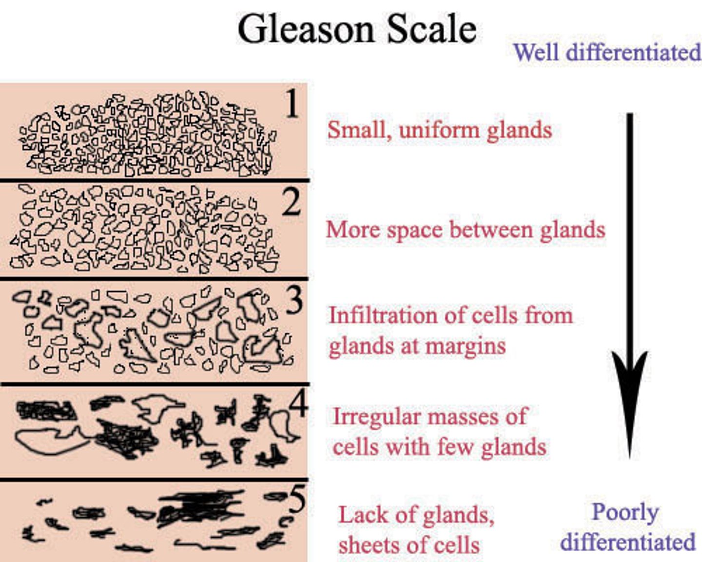<p>Preferred system of tumor grading; a higher score is consistent w/ more advanced disease and/or worse prognosis of localized disease</p>