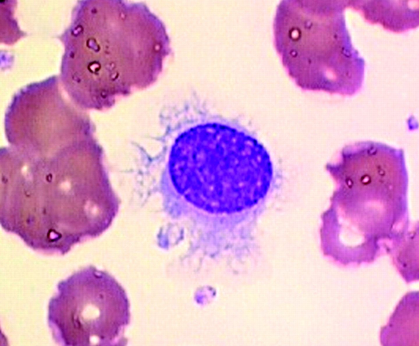<ul><li><p>Rare B cell malignancy.</p></li></ul><ul><li><p>cells are fragile and mononuclear</p></li><li><p>Hair-like projections of the cytoplasm.</p></li><li><p>Spongy appearance of chromatin.</p></li><li><p>Diagnosis with cytochemical stain tartrate-resistant acid phosphatase (TRAP) </p><ul><li><p>other cells don’t stain with the tartrate</p></li></ul></li></ul><p></p>