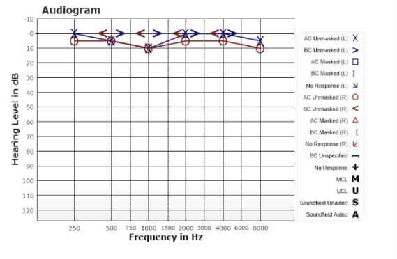 <p>How would you describe this audiogram?</p>