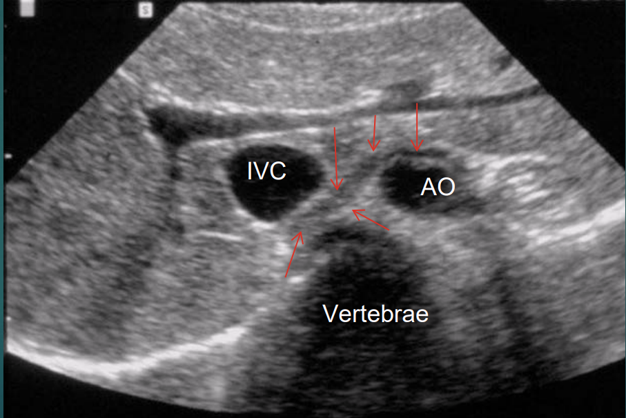 <ul><li><p>musculotendinous bands that arise from anterior surface of the first 3 lumbar vertebrae</p></li><li><p>right and left crura</p><ul><li><p>right is longer and passes anteriorly to the aorta and posterior to IVC</p></li></ul></li></ul><p></p>