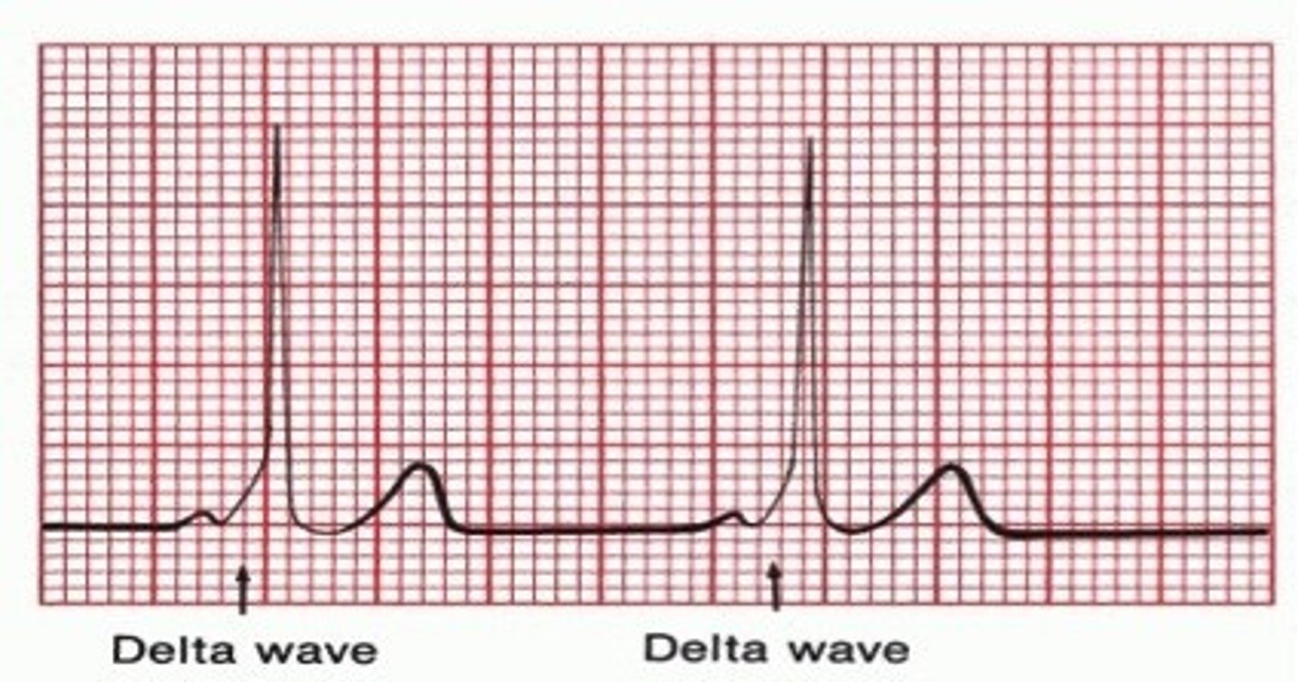 <p>Unstable: Cardioversion</p><p>Chronic: Ablation</p>