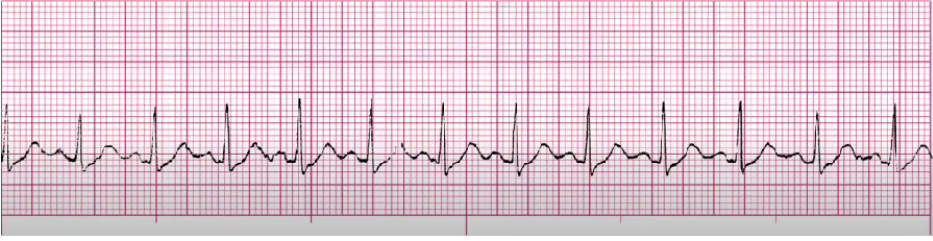 <p>If sx: TAKE BP!</p><p>treat underlying cause (usually compensation)</p><p>meds to slow HR: BB, Ca Channel Blocker</p><p>Dehydrated? IVF</p><p>pain meds</p><p>cut back on smoking/caffeine</p>