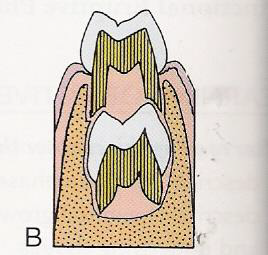 <p>Q: What causes the change in position of the permanent premolars during the Preeruptive Phase?</p>