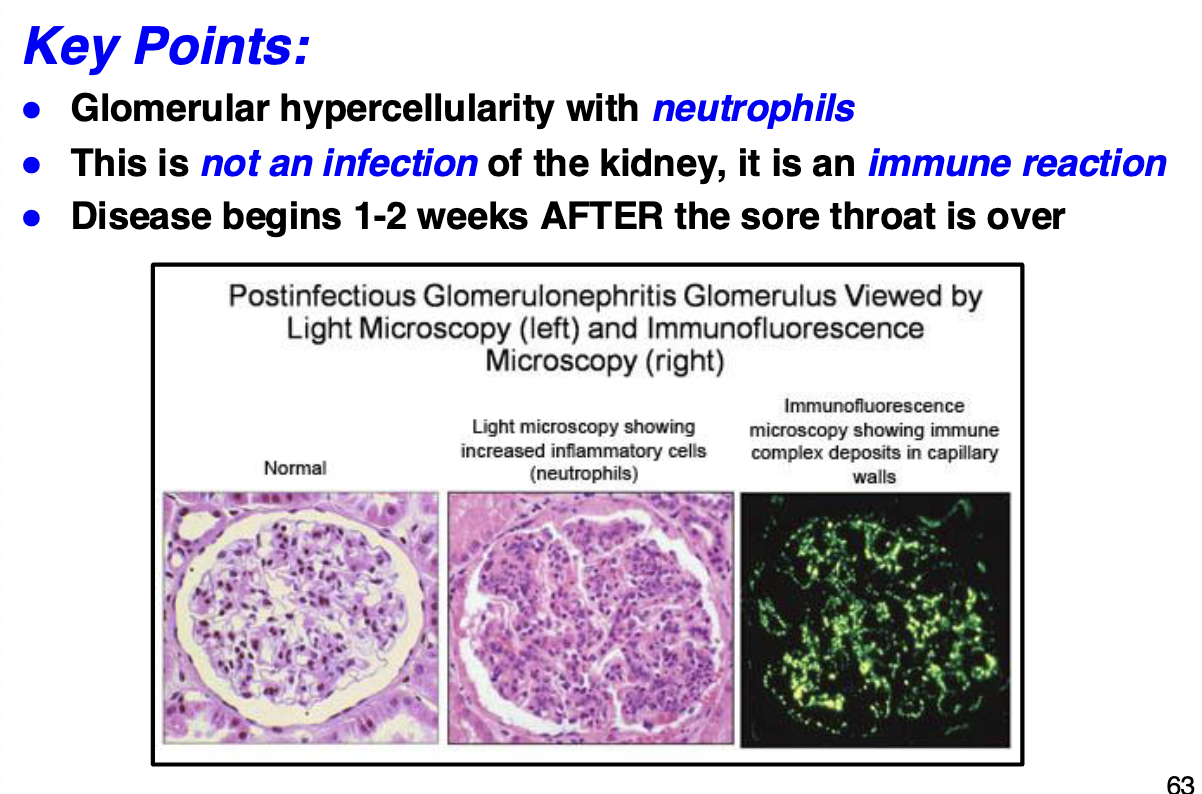 <ul><li><p>disease prototype is post-infectious glomerulonephritis usually after group A B-hemolytic streptococci infection</p></li><li><p>usually in children, in ab 1-3% cases this occurs ab 1-2 weeks after strep throat infection</p></li><li><p>prompt antibiotic treatment can prevent possible kidney damage</p></li><li><p>95% recover, 5% progressive to chronic renal disease</p></li><li><p>glomerular inflammation caused by an autoimmune reaction of to glomerular (self) antigens (anti-<strong>glomerular IgG antibodies</strong>)</p></li><li><p>immune complexes induce Type III hypersensitivity reaction and activate complement, that recruit neutrophils</p></li><li><p>glomerular histology shows diffuse proliferation of glomerular cells and presence of neutrophils</p></li></ul><p></p>
