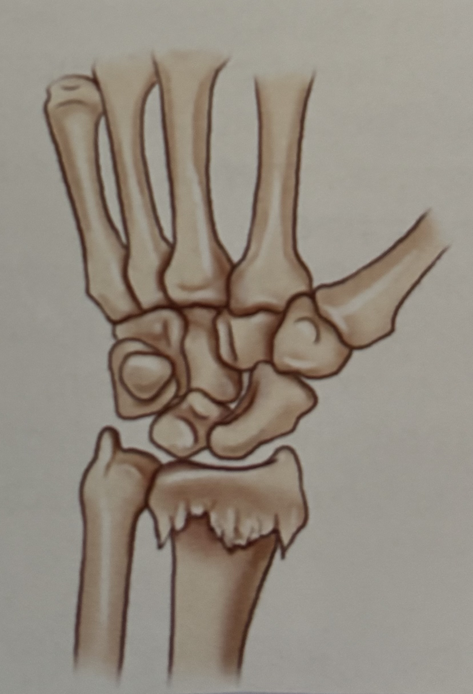 <p>What type of fracture is this?</p>