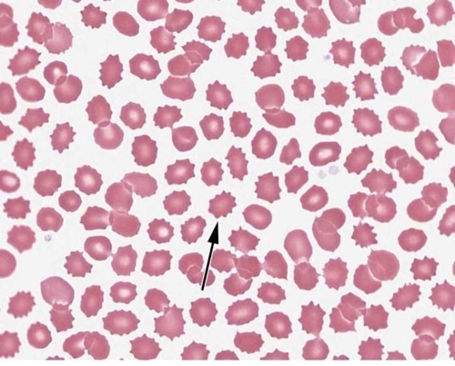 <p>Echinocyte</p>
