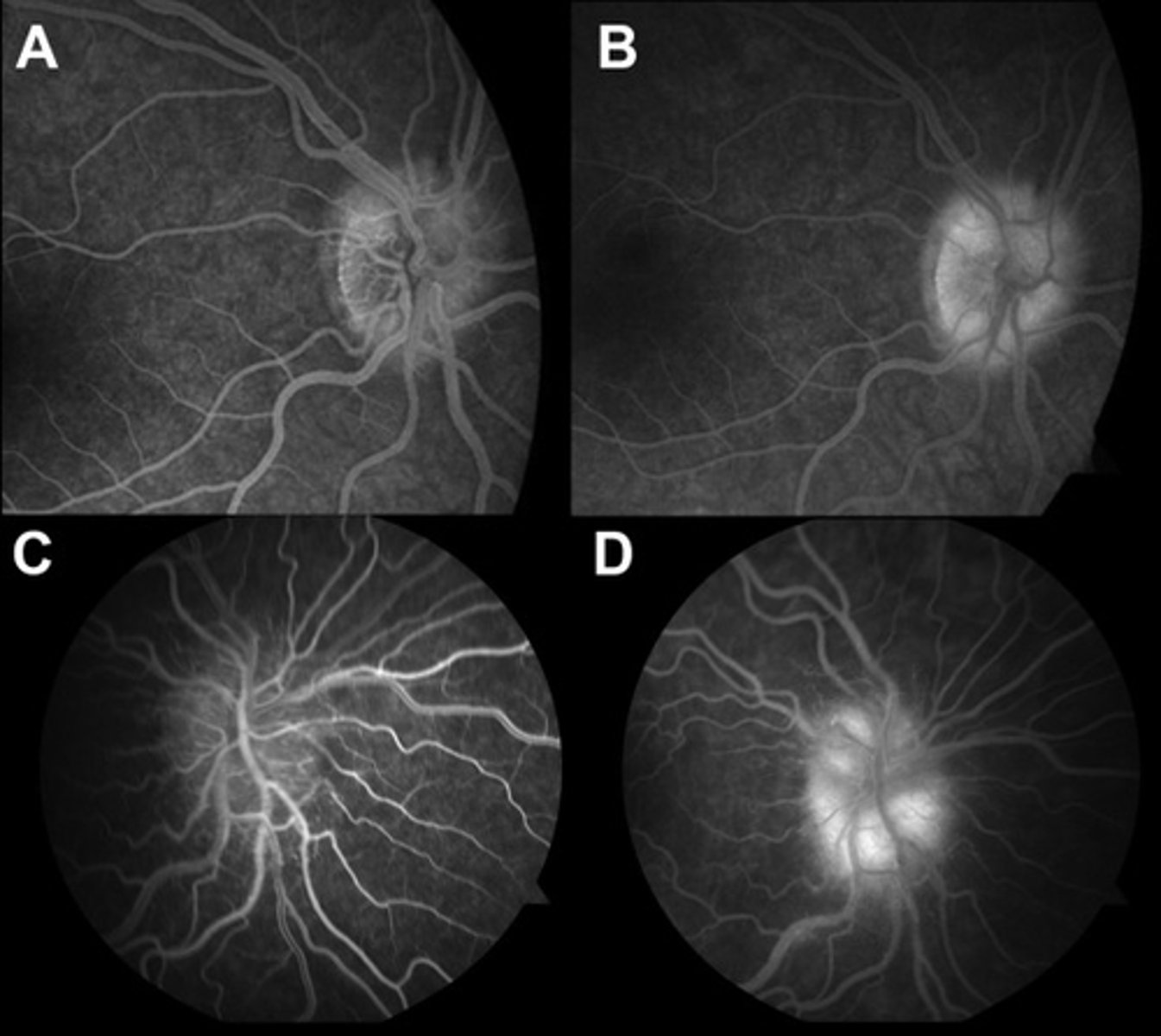 <p>early and late diffuse leakage</p>