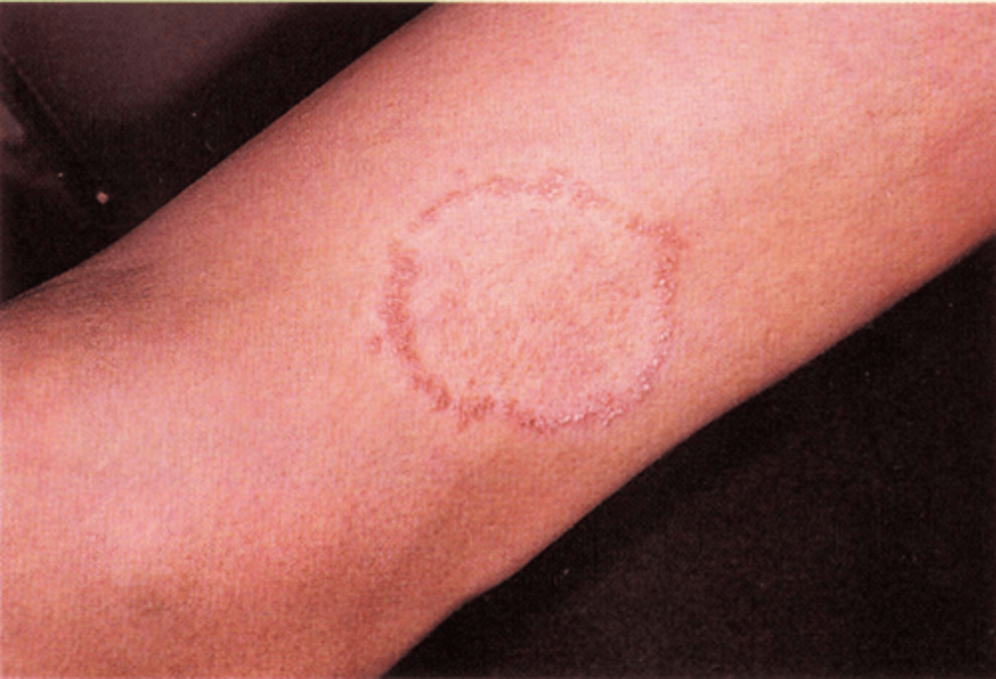 <p>margin of lesion shows greater activity than center (tinea eruptions)</p>