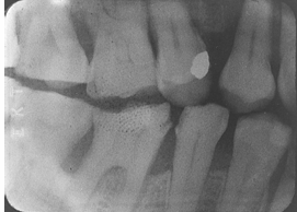 <p>What is the problem with this FOGGED FILM X-ray?</p>