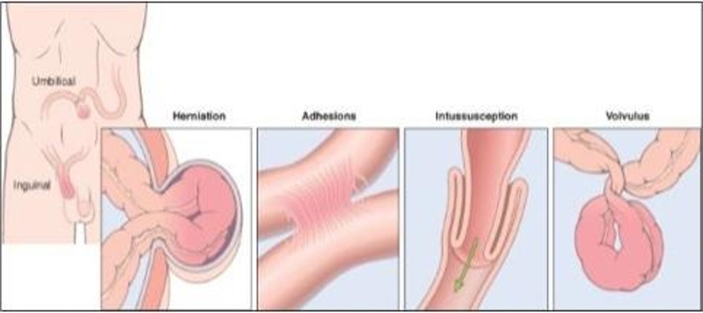 <p>ileum telescopes into cecum, pain obstruction, edema, bowel ischemia, rectal bleeding (CURRANT JELLY stools)</p>