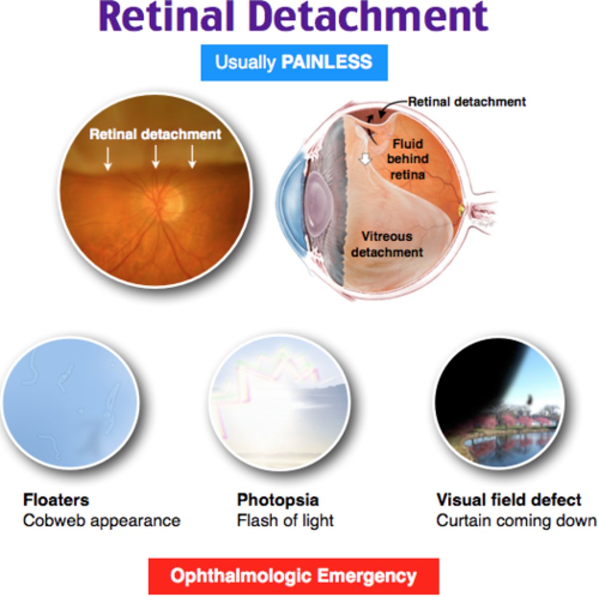 <p>Thin layer of tissue lining the back of the eye</p>