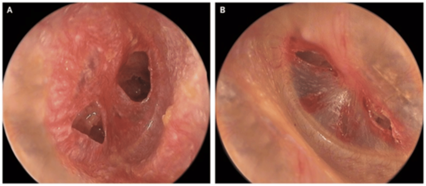 <p>Otoscopy demonstrates a perforation in the TM<br><br>Do not perform pneumatic otoscopy with a TM perforation- can damage the middle ear!<br><br>Vestibular and hearing assessment should be performed to assess the patient's balance and hearing</p>