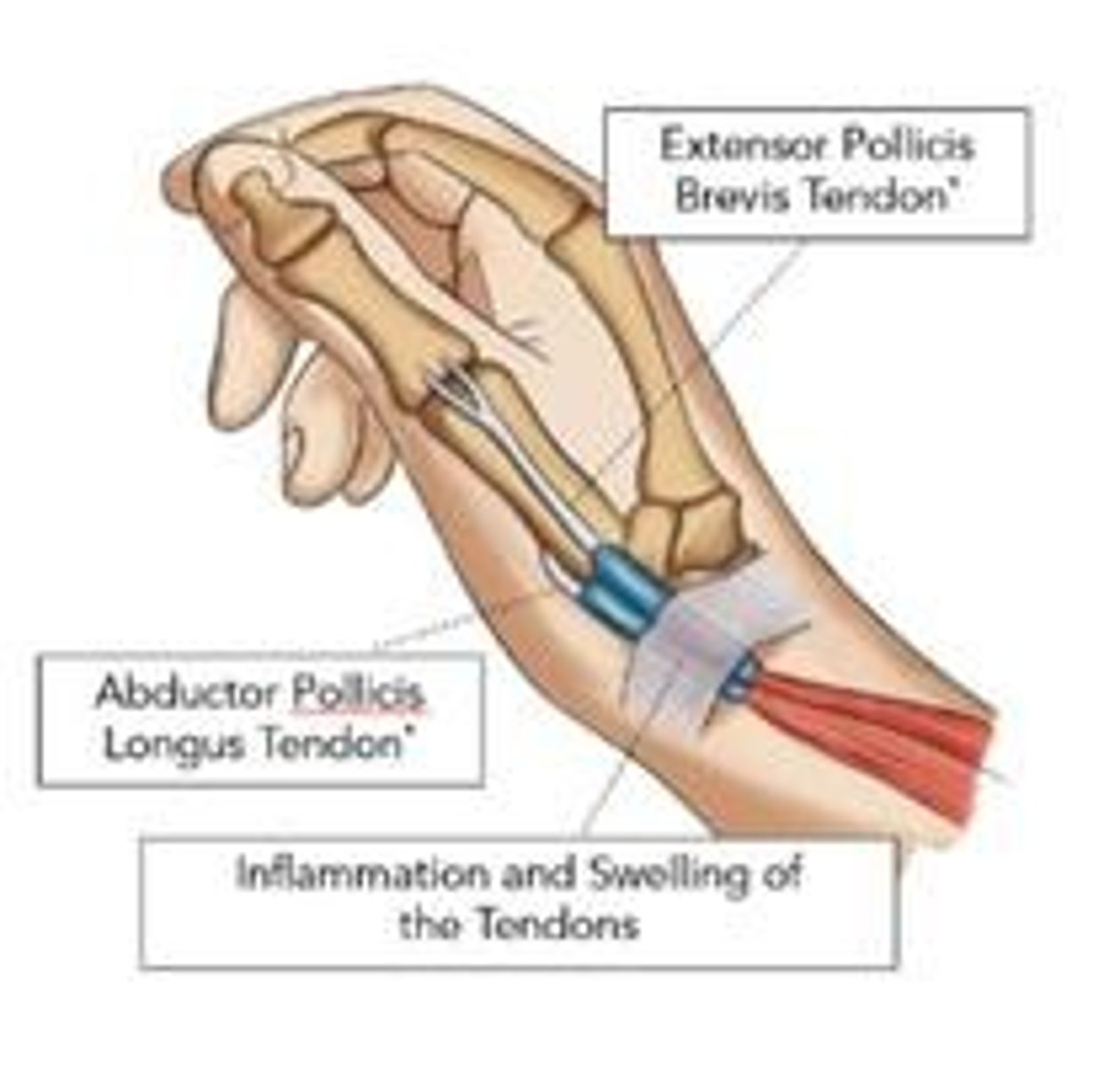 <p>Carpal tunnel syndrome</p>