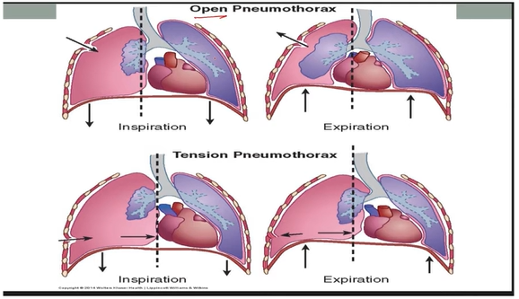 <p>Air accumulation in pleural space → partial or complete collapse</p><p>Types:</p><ul><li><p>Spontaneous Pneumothorax (Primary)</p><ul><li><p>Air blister (bleb) on lung surface bursts</p></li><li><p> young, healthy, tall ppl</p></li></ul><p>Traumatic Pneumothorax (Secondary)</p><ul><li><p>Chest injury (rib fracture, stab, or gunshot wound)</p></li></ul><p>Open Pneumothorax (Communicating)</p><ul><li><p>Air moves in and out of pleural space</p></li><li><p>Pressure inside = outside air pressure</p></li></ul><p>Tension Pneumothorax</p><ul><li><p>Air enters but cannot escape</p></li><li><p>Pressure builds up in pleural space → compresses lung</p></li><li><p>Tracheal deviated to the unaffected side & mediastinal shift</p></li></ul></li></ul><p>s/s:</p><ul><li><p>Pain, SOB, Tachypnea, Hyperresonance, absent breath sounds</p></li></ul><p>d/x: CXR, CT, O2, ABGs</p><p>t/x:</p><ul><li><p>chest tube or large bore needle</p></li></ul><p></p>