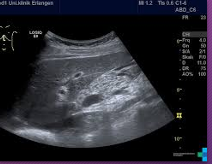 <p>Pancreatic lipomatosis is _____ that _____ or _____ the pancreas</p>