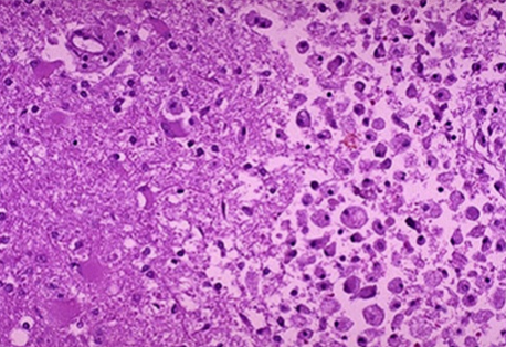 <p>What kind of necrosis is this</p>