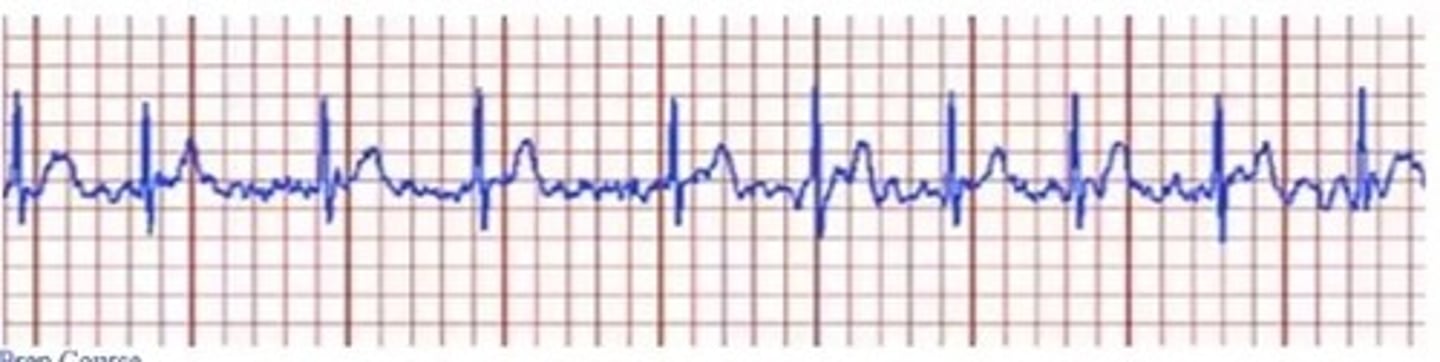 <p>C. Atrial Fibrillation; Stop exercise and report to the physician</p><p>A. QRS looks normal</p><p>PVC - no P wave</p>