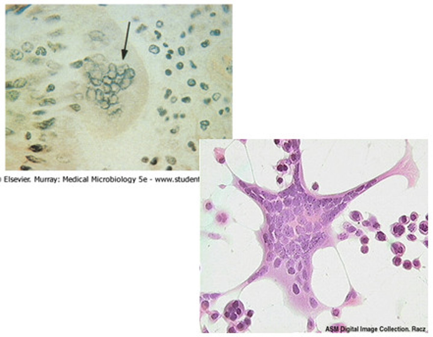<p>Multinucleate cell which results from multiple cell fusions of uninuclear cells.</p>