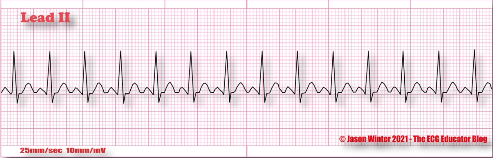 <p>What does this EKG represent?</p>