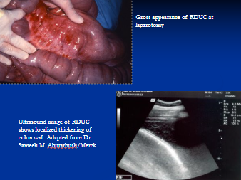 <p><span style="background-color: transparent;">Right dorsal colitis</span></p>