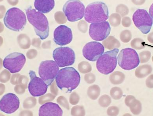 <p>Most common cancer in children, causing rapid proliferation of pre-B lymphoblasts in bone marrow</p><p><u>Pathogenesis</u>: numerical or structural chromosomal changes causing bone marrow to be packed with rapidly dividing pre-B lymphoblasts which fail to mature</p><p><u>Diagnosis</u>:</p><ul><li><p>Anaemia, neutropenia, thrombocytopenia (pancytopenia)</p></li><li><p>Bone pain</p></li><li><p>Lymphadenopathy, splenomegaly, hepatomegaly</p></li><li><p>Blood film and biopsy: circulating lymphoblasts</p></li><li><p>Immunohistochemistry: TdT, CD10, CD19, CD20</p></li></ul><p><u>Treatment</u>: invasive chemotherapy followed by consolidation and maintenance</p><p><u>Prognosis</u>: if hyperdiploidy (>50 chromosomes/ cell) - good prognosis</p><p></p>