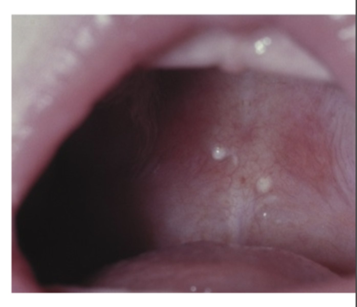 <p>Where are palatal cysts of the newborn found? how do they appear? what is the treatment? </p>
