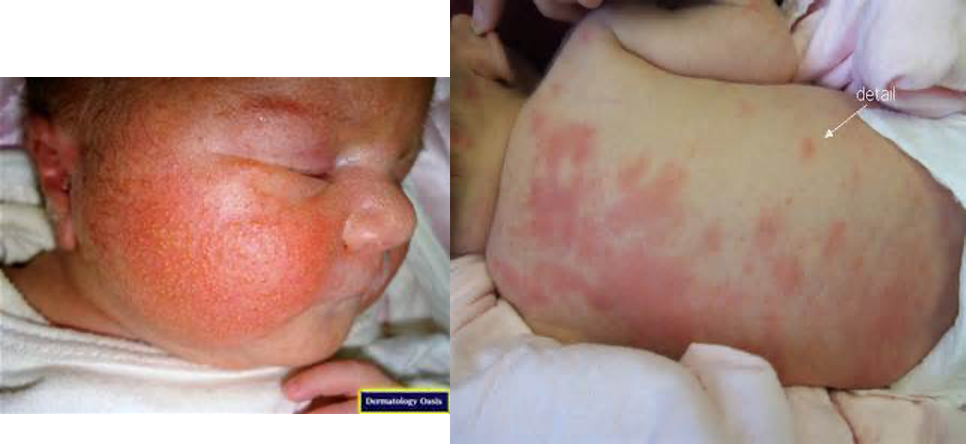 <p>What is a benign <strong>newborn rash</strong> of variable irregular macular patches that is self limiting &amp; lasts a few days?</p>