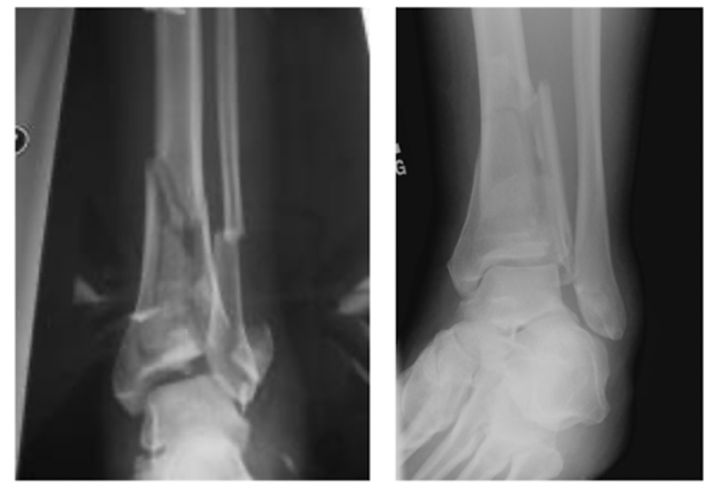 <p>pilon fracture</p>
