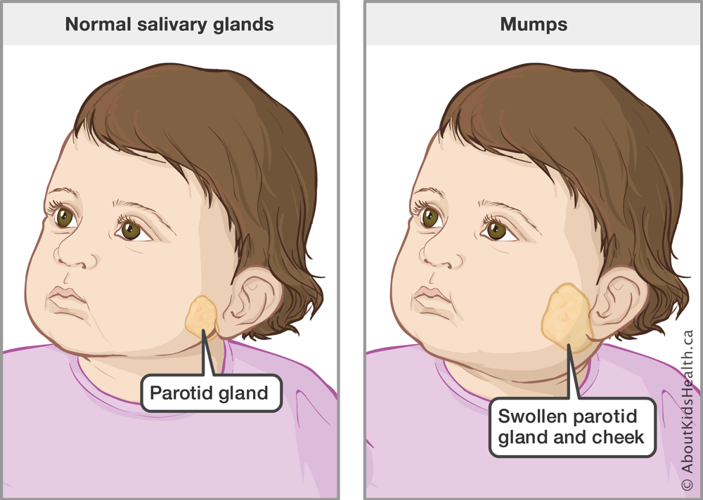 <ul><li><p><strong>inflammation of the parotid gland.</strong></p></li></ul><ul><li><p>highly infectious/self-limiting infection. </p></li><li><p>Causes massive swelling of parotid glands and can cause harm if swelling of testes occurs.</p></li></ul><p></p>