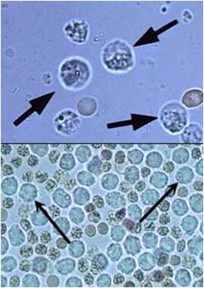 <p>granular appearance</p><p>origin: Kidney, bladder, or urethra</p><p>clinical significance: Cystitis, pyelonephritis, tumors, renal calculi.</p>