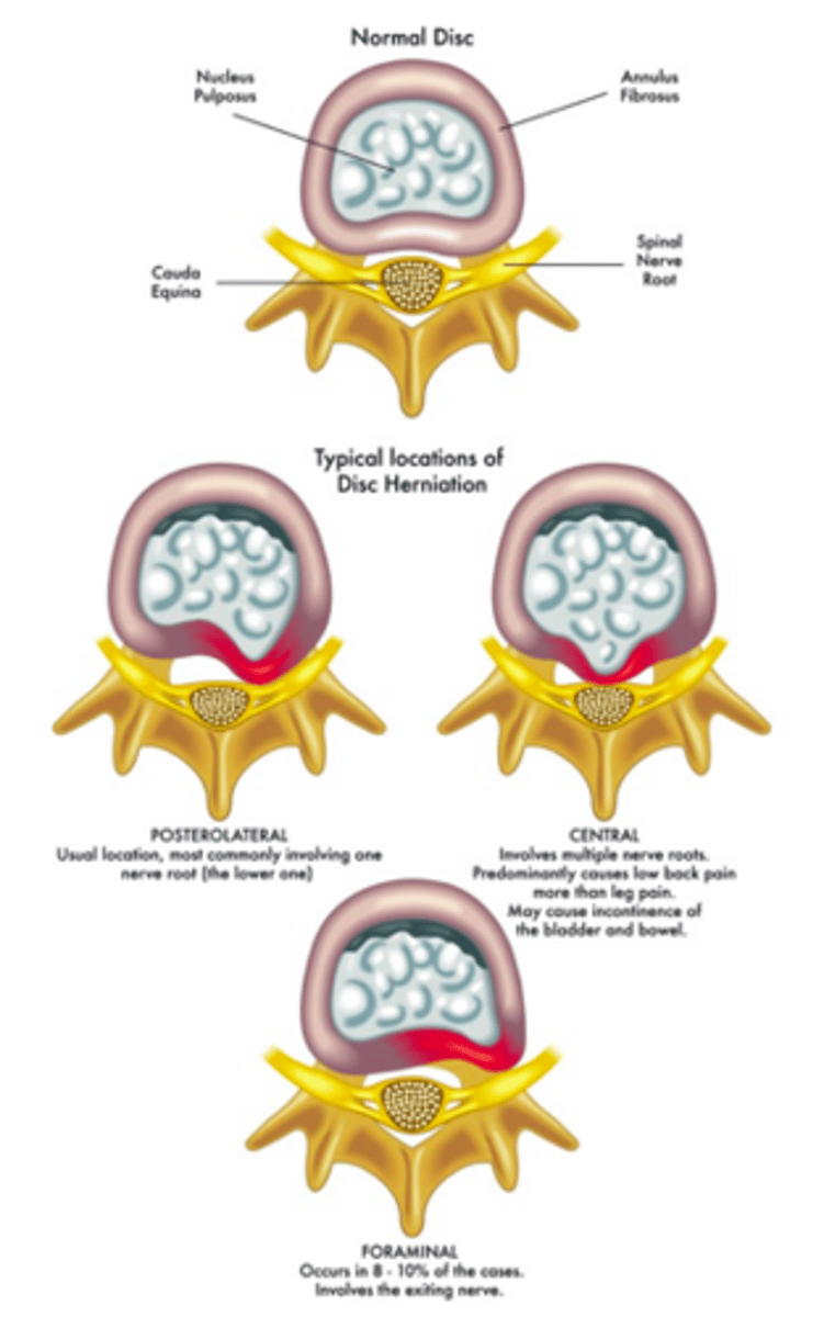 <p>Foraminal prolapse (disc herniation)</p>