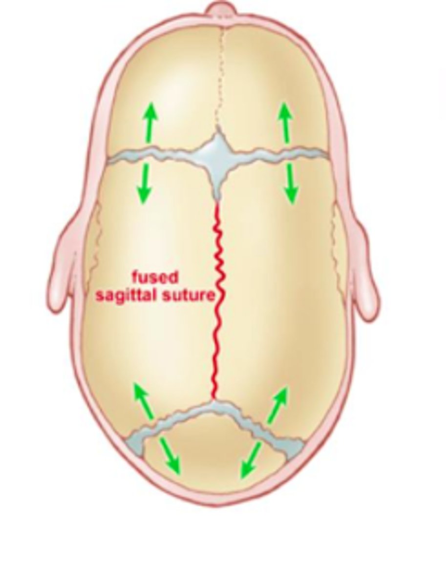 <p>Premature fusing of sutures</p>