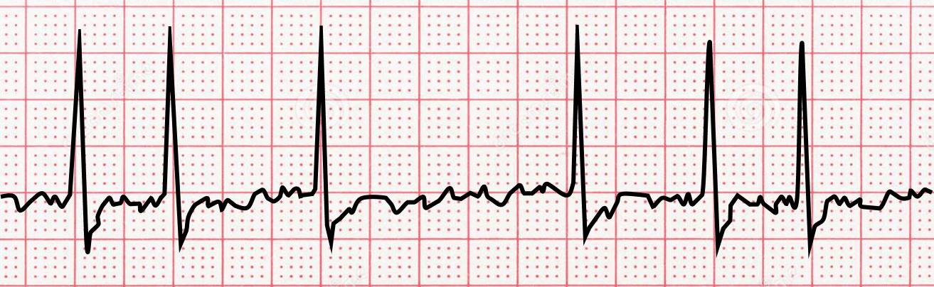 <p>name  ECG pattern</p>