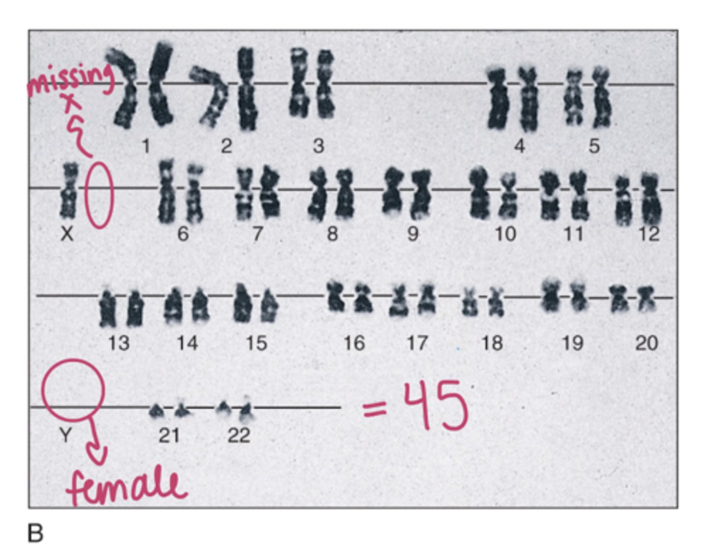 <p>a chromosomal disorder in females in which either an X chromosome is missing, leading to 45 chrosomes (-1)</p><p>short statue, webbing neck, lack of secondary sex characteristics, absent ovaries, coartctation of aorta and bicuspid aortic valve, some difficulty driving and nonverbal problem solving</p>