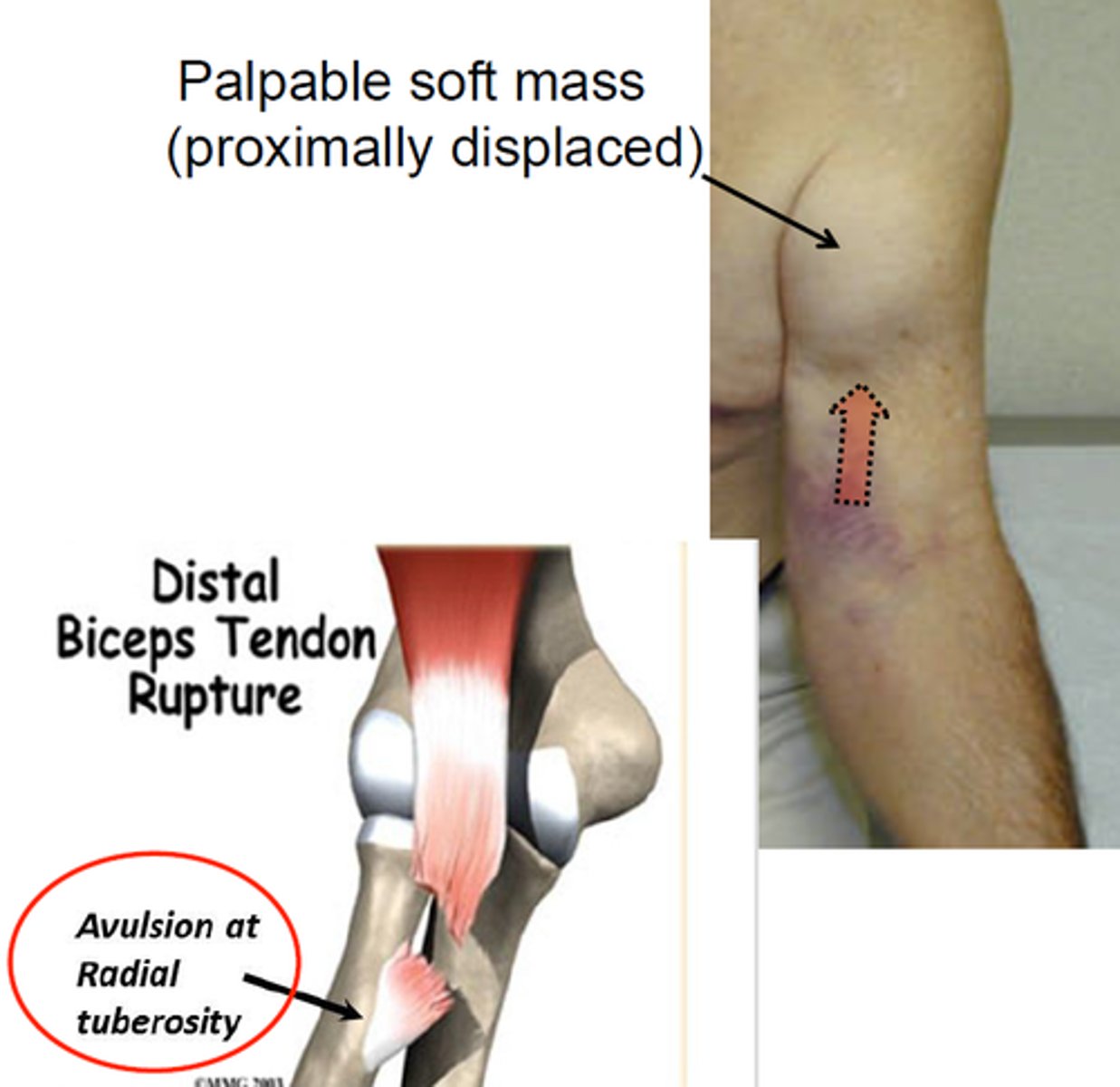 <p>biceps tendon - proximal or distal</p><p>"Popeye" contract in a ball</p>