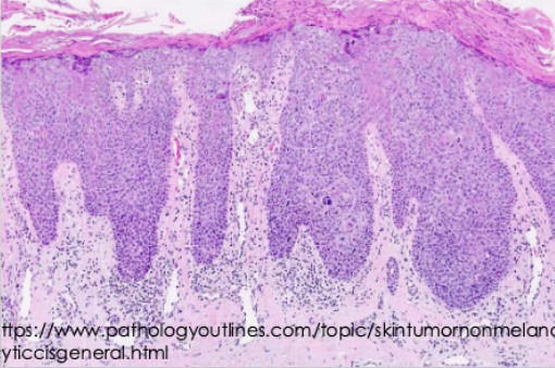 <p>Bowen disease</p>