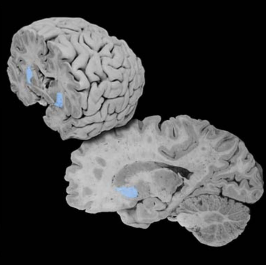 <p>Putamen</p>