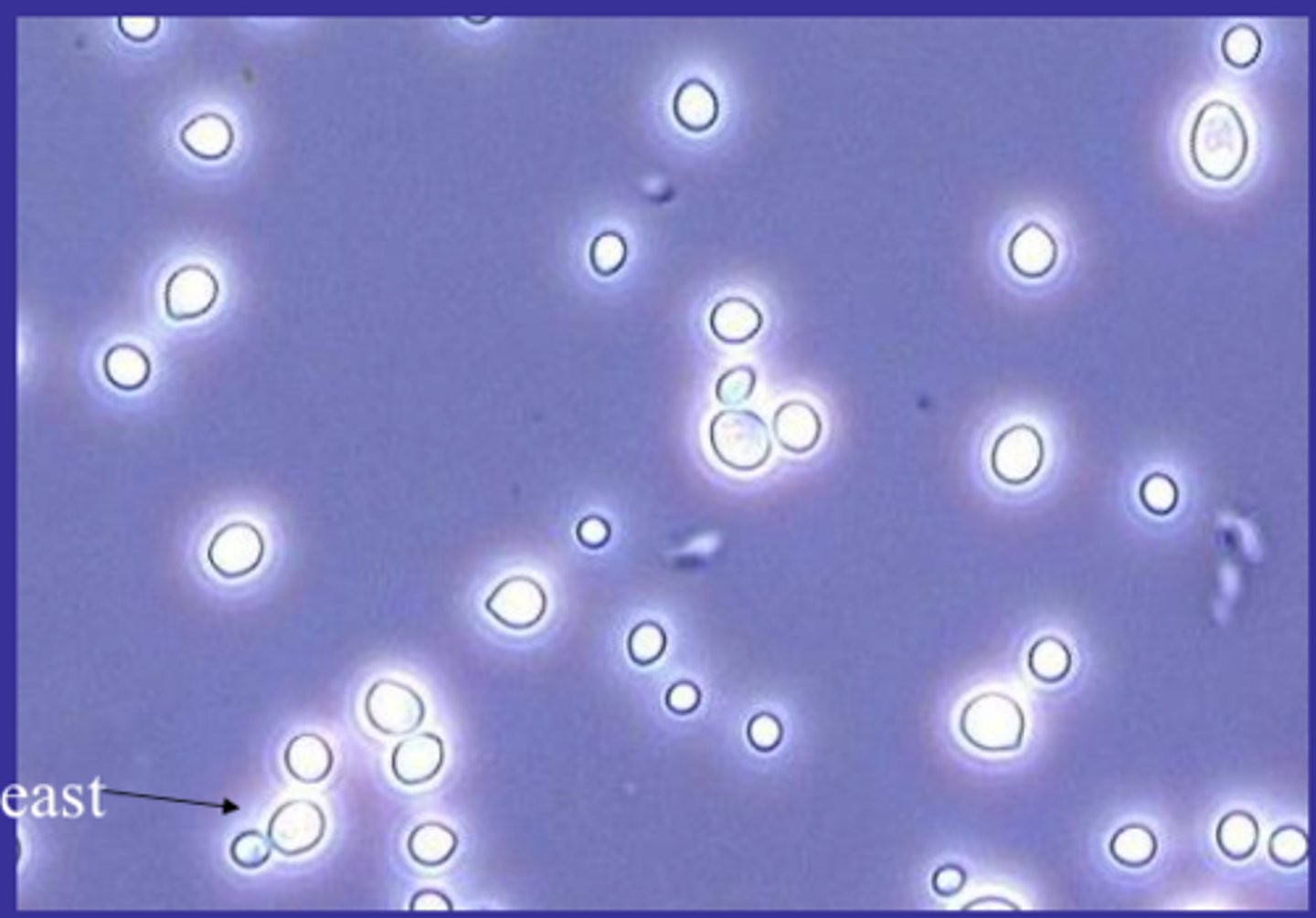 <p>They appear as small, refractile oval structures that may or may not contain a bud. (Budding is the best way to confirm in a specimen though). In severe infections they may as appear as branched mycelial forms</p><p>- Primarily Candida albicans, seen in the urine of diabetic patients, immunocompromised or women with vaginal moniliasis</p><p>- A true yeast infection SHOULD be accompanied by WBCs</p>