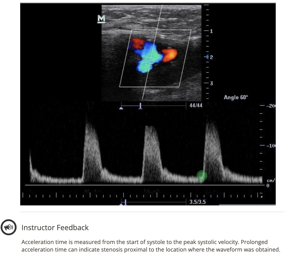 <p>start of 3rd waveform</p>