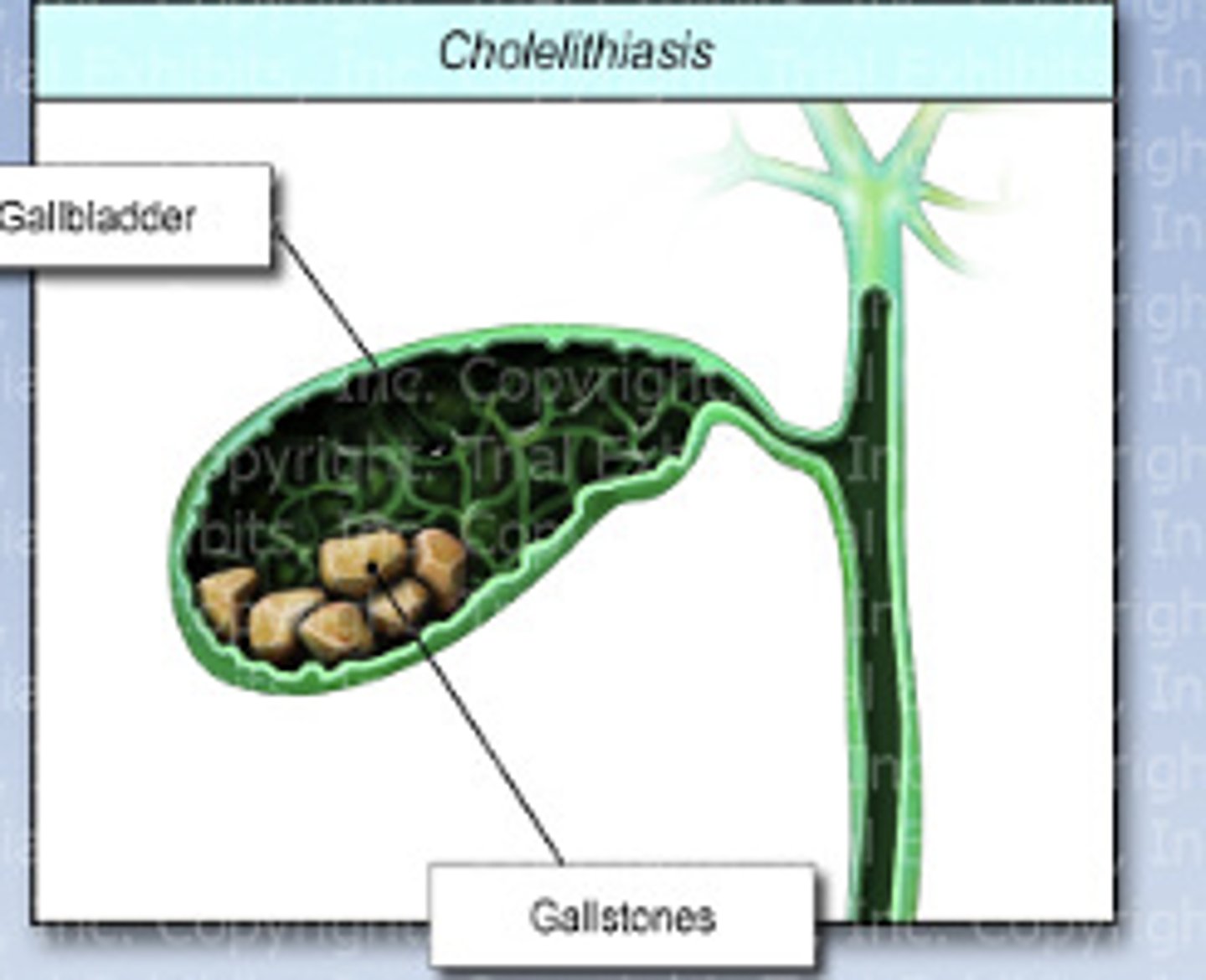 <p>The presence of one or more gallstone in the gallbladder or biliary ducts</p>