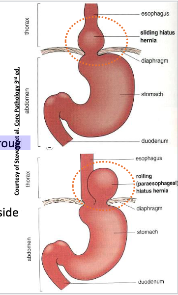 <p>Paraesophageal (Rolling)</p>