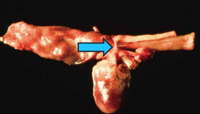 <p><span style="background-color: transparent;"><strong><span>Persistent Right Aortic Arch</span></strong></span></p>
