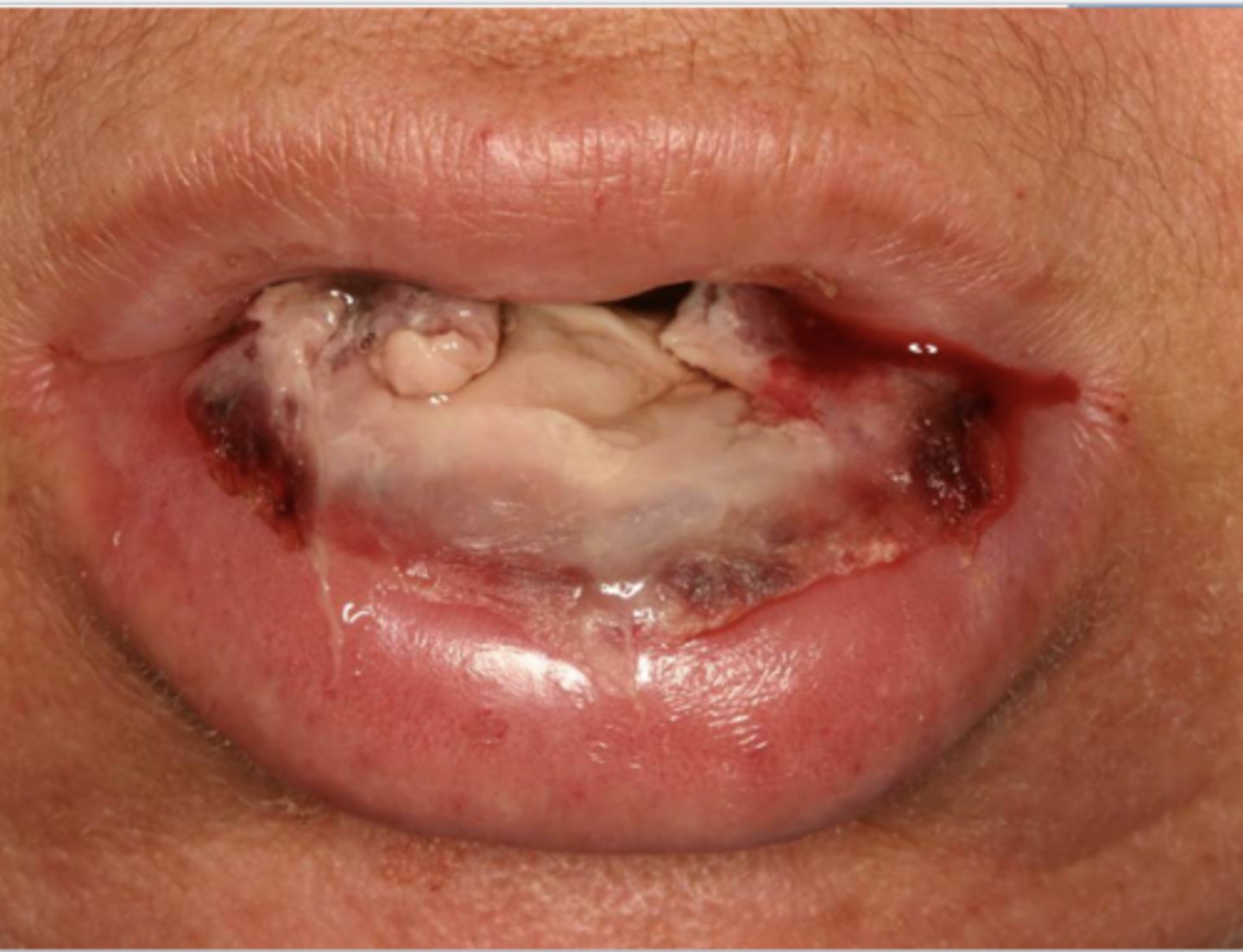 <p>Patient has lung cancer & is currently undergoing chemotherapy. What do you suspect?</p>